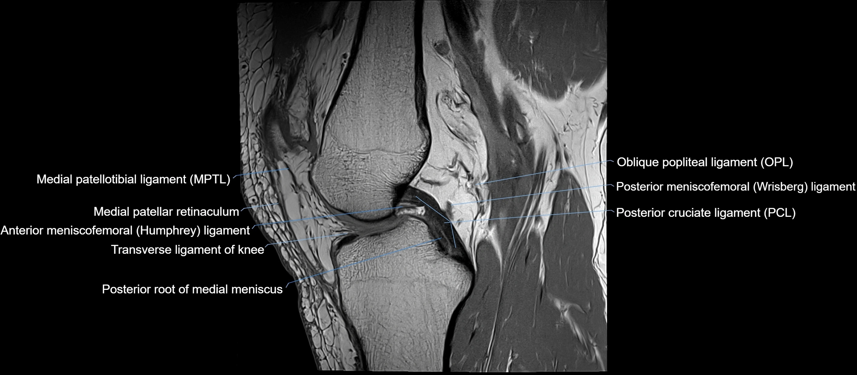 MRI sagittal  ligaments cross sectional anatomy 3T  radiology  image-img-00001-00023.webp